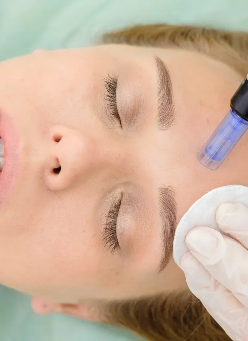 Microneedling in Fayetteville, TN